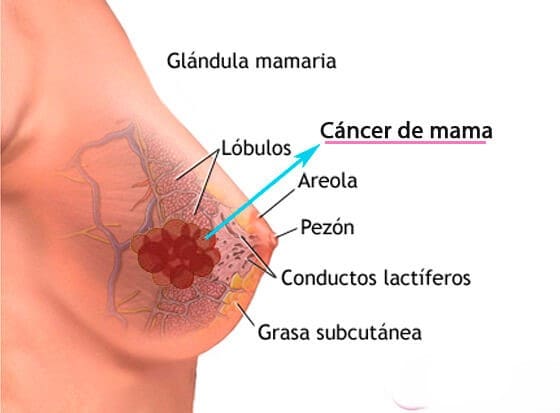 Cáncer de mama