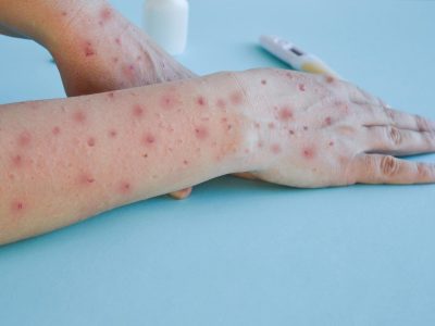 Monkey pox virus, a new world problem of modern humanity. Close-up of the hands of a sick person with pimples and blisters. Smallpox vaccine.