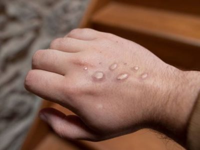 Monkey pox vesicles in a hand